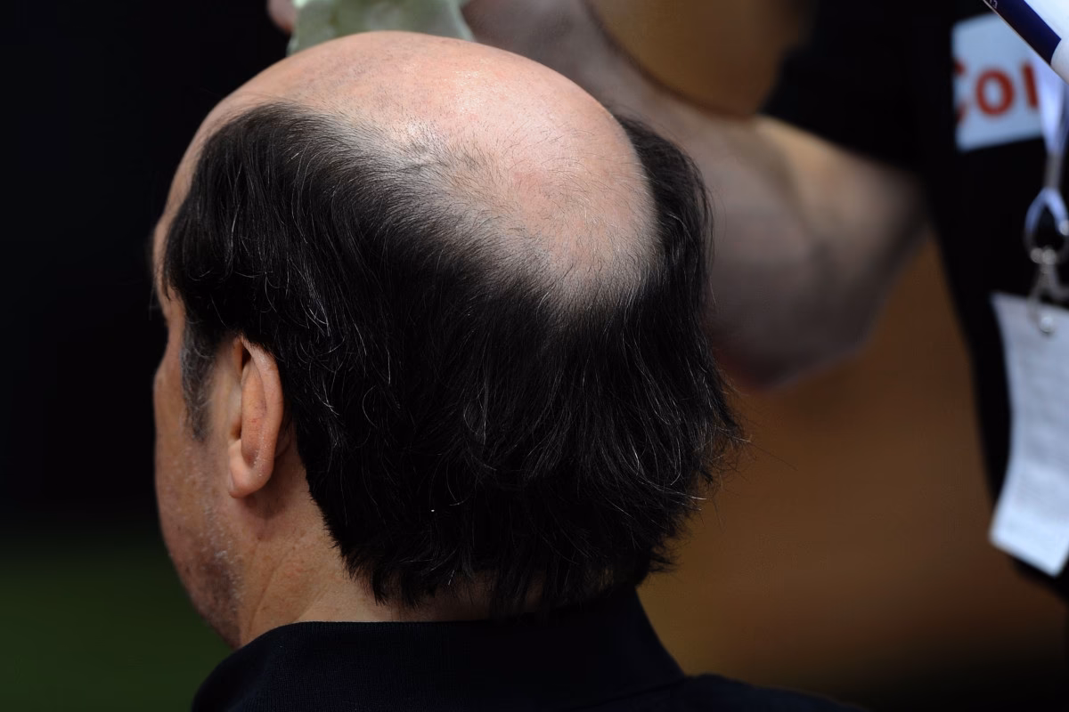 Quels sont les différents types de coiffure chauve ?