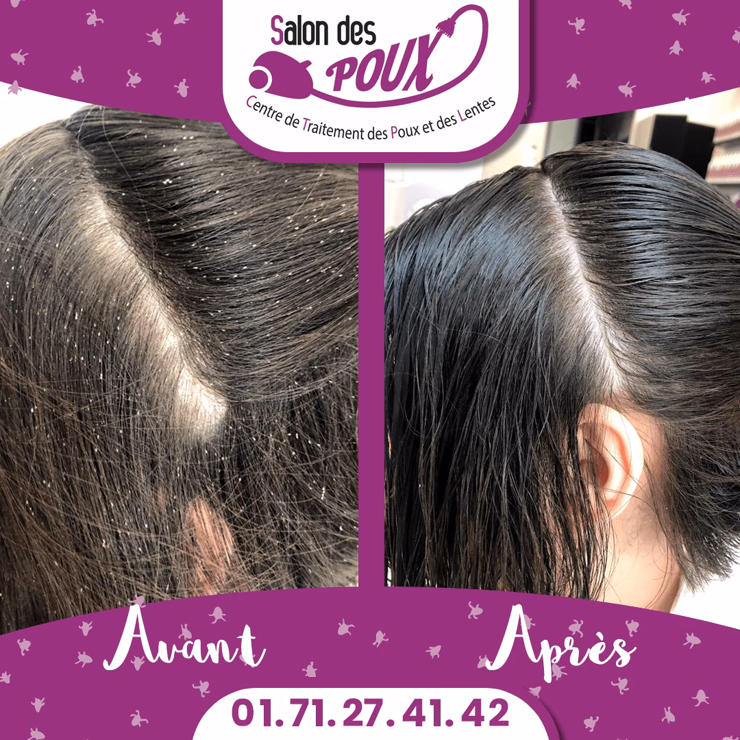 Quels sont les différents types de coiffures anti-poux ?