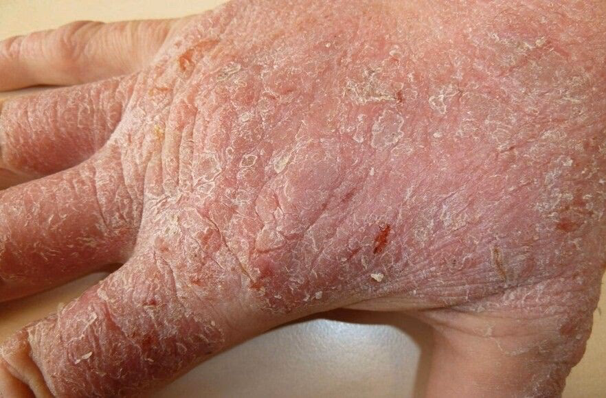 Welche Allergien gibt es beim Friseur?