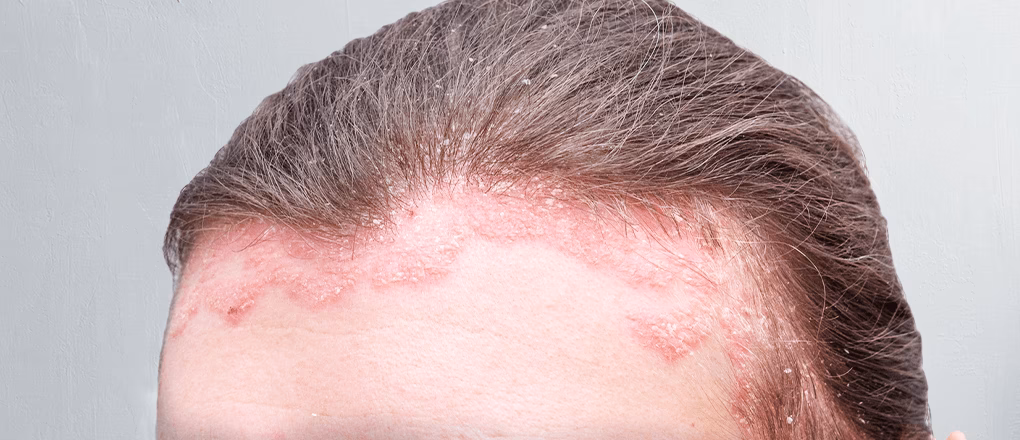 Was ist eine Kopfpsoriasis (Psoriasis capitis)?