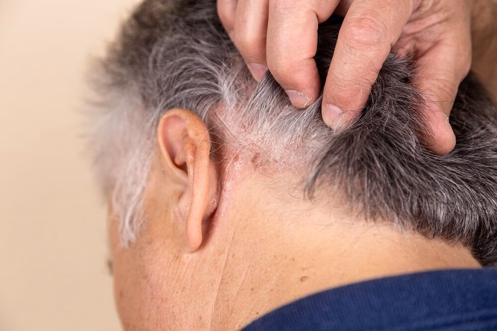 Ist Psoriasis capitis ansteckend?